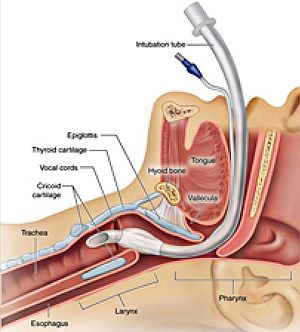 Positioning for Trach Reinsertion