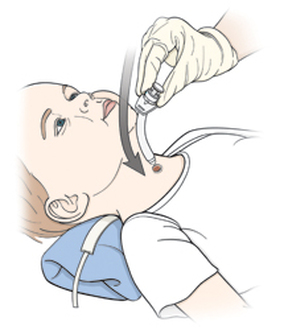 Complications During Tube Replacement