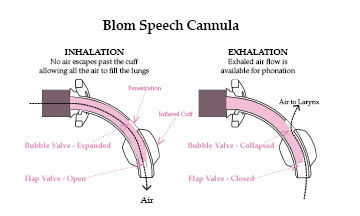 Figure: Airflow with Blom tracheostomy. Reprinted with permission of Dr. Eric Blom