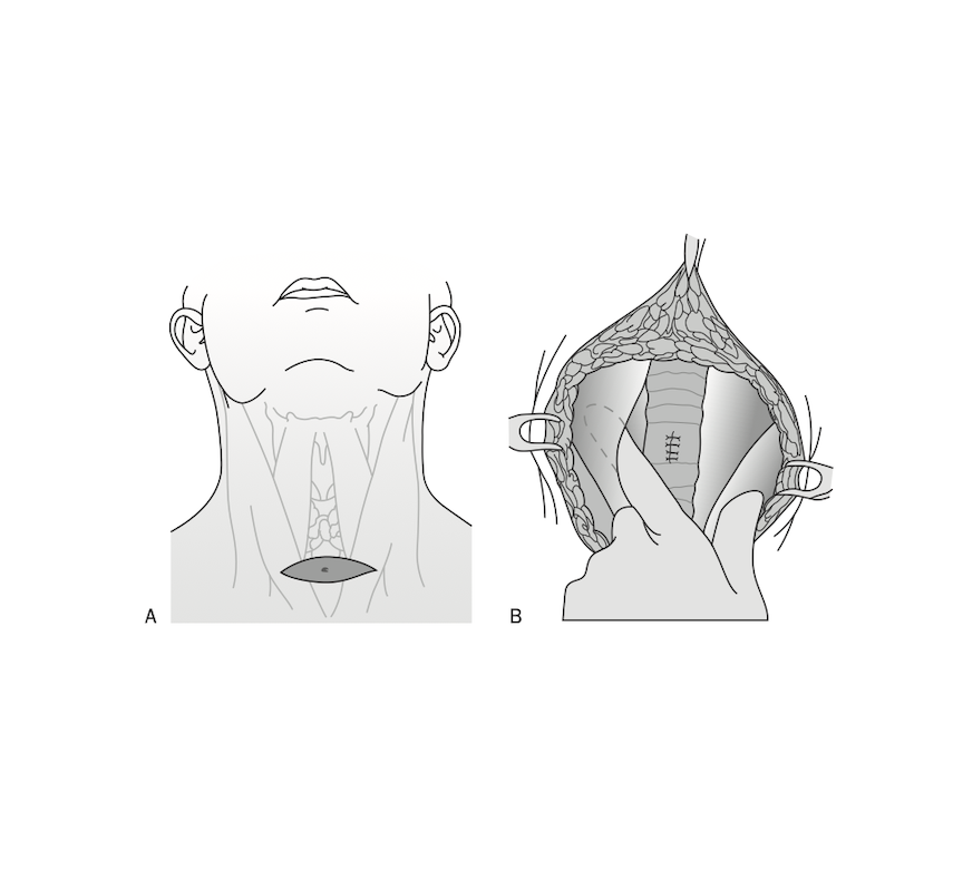 Figure: Repair of tracheocutaneous fistula | ©Linda L. Morris and M. Sherif Afifi. All rights reserved.
